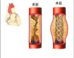 【图片】潍坊心脏病的介入治疗首选青州中医院